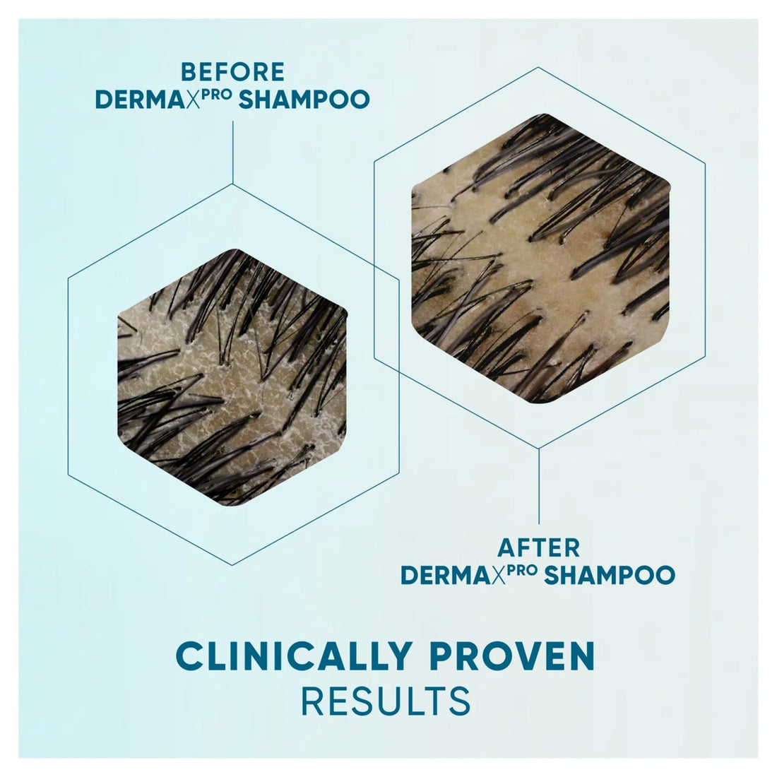 שמפו הד אנד שולדרס דרמה אקס פרו DERMA X PRO לטיפול בקרקפת יבשה ומגרדת עם אלוורה ותמצית קקטוס 300 מ"ל Head & Shoulders Soothing Comfort