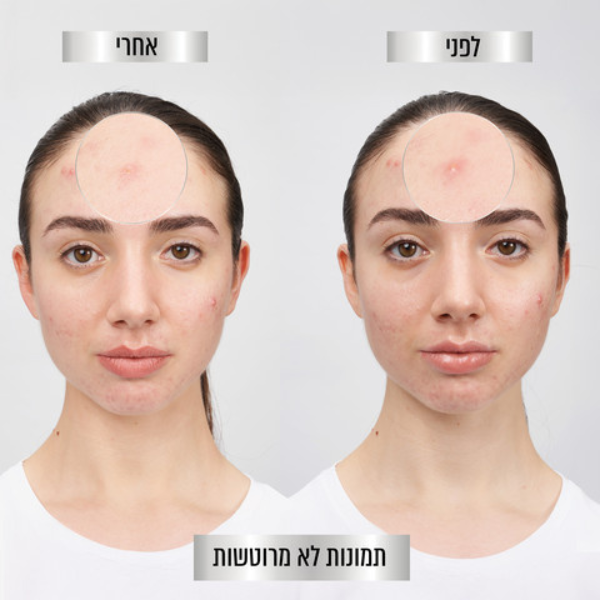 מדבקות פצעונים שקופות Garnier Pure Active 8H Invisible Acne Patches - טיפול ממוקד ב-22 יחידות