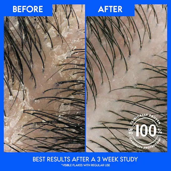 Head & Shoulders | הד אנד שולדרס - Apple Cider Vinegar | שמפו לטיהור עמוק מועשר בחומץ תפוחים (625 מ"ל)